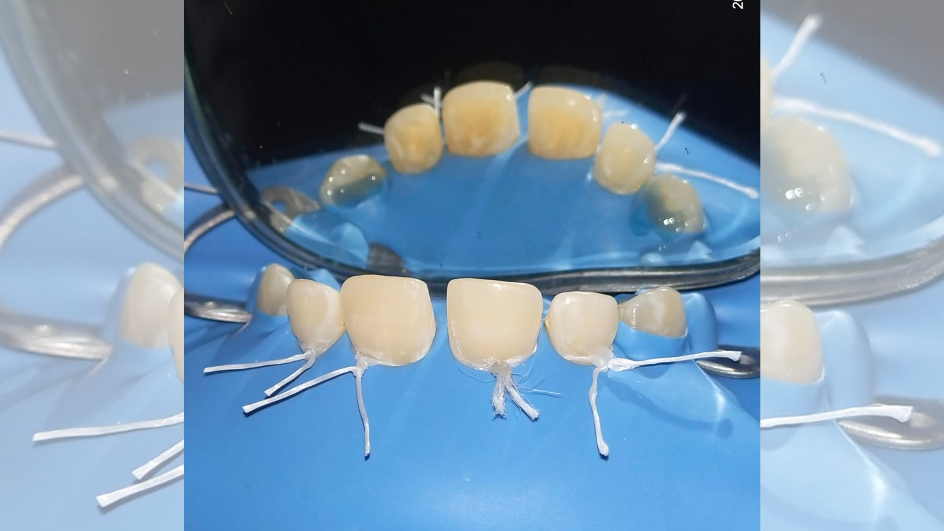 Diastema Closure 1