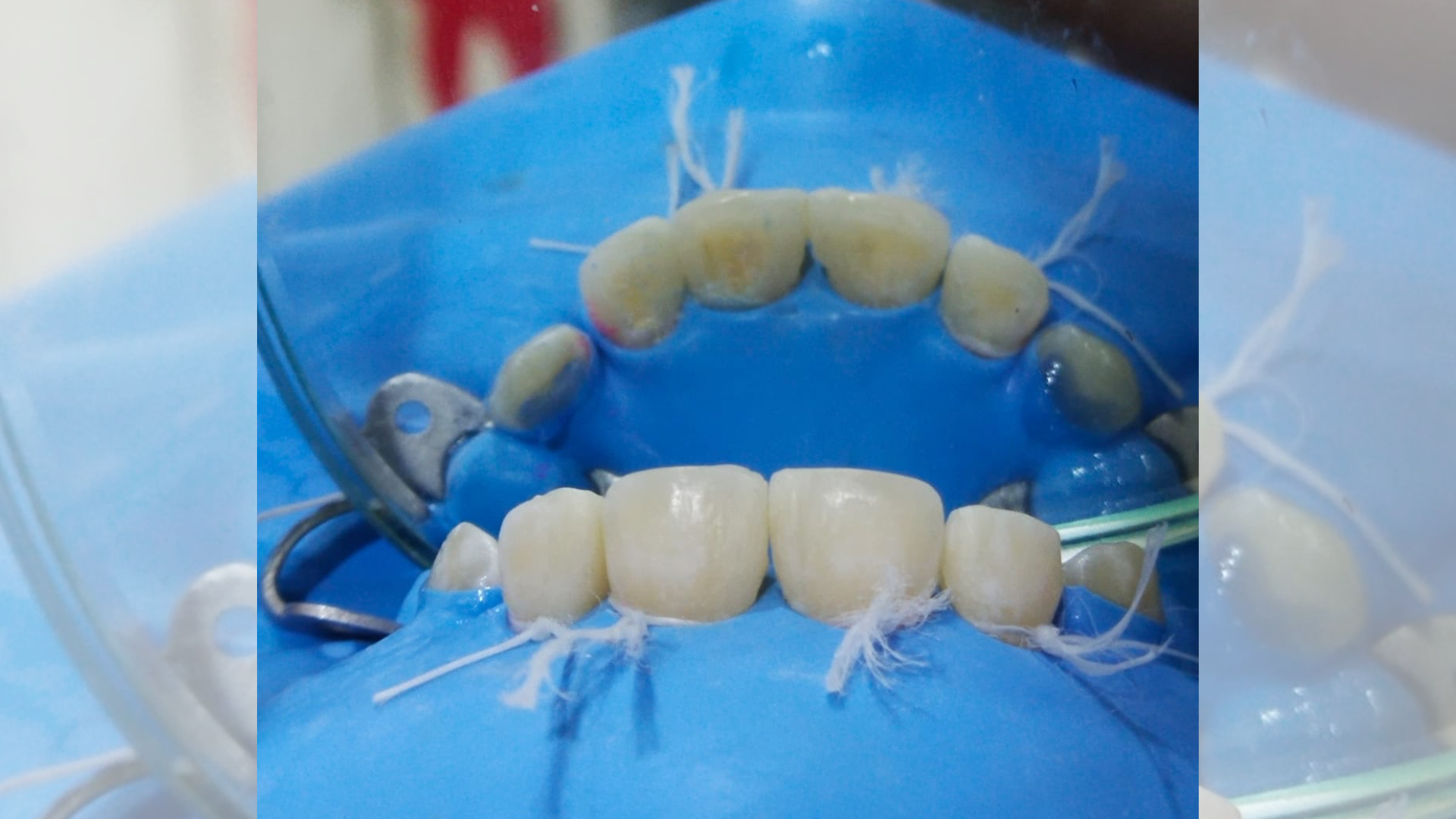 Diastema Closure 2