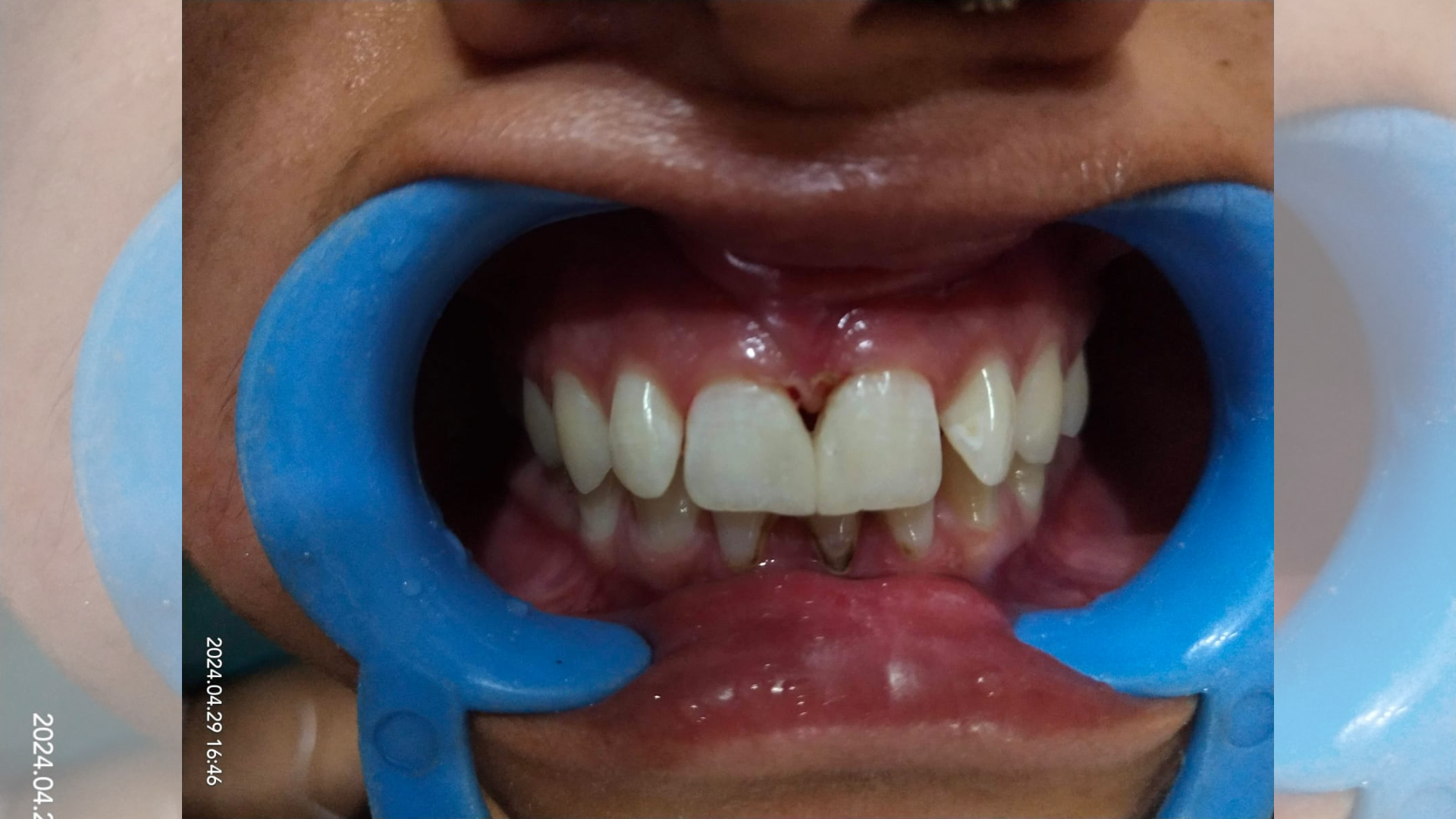 Midline Closure 1