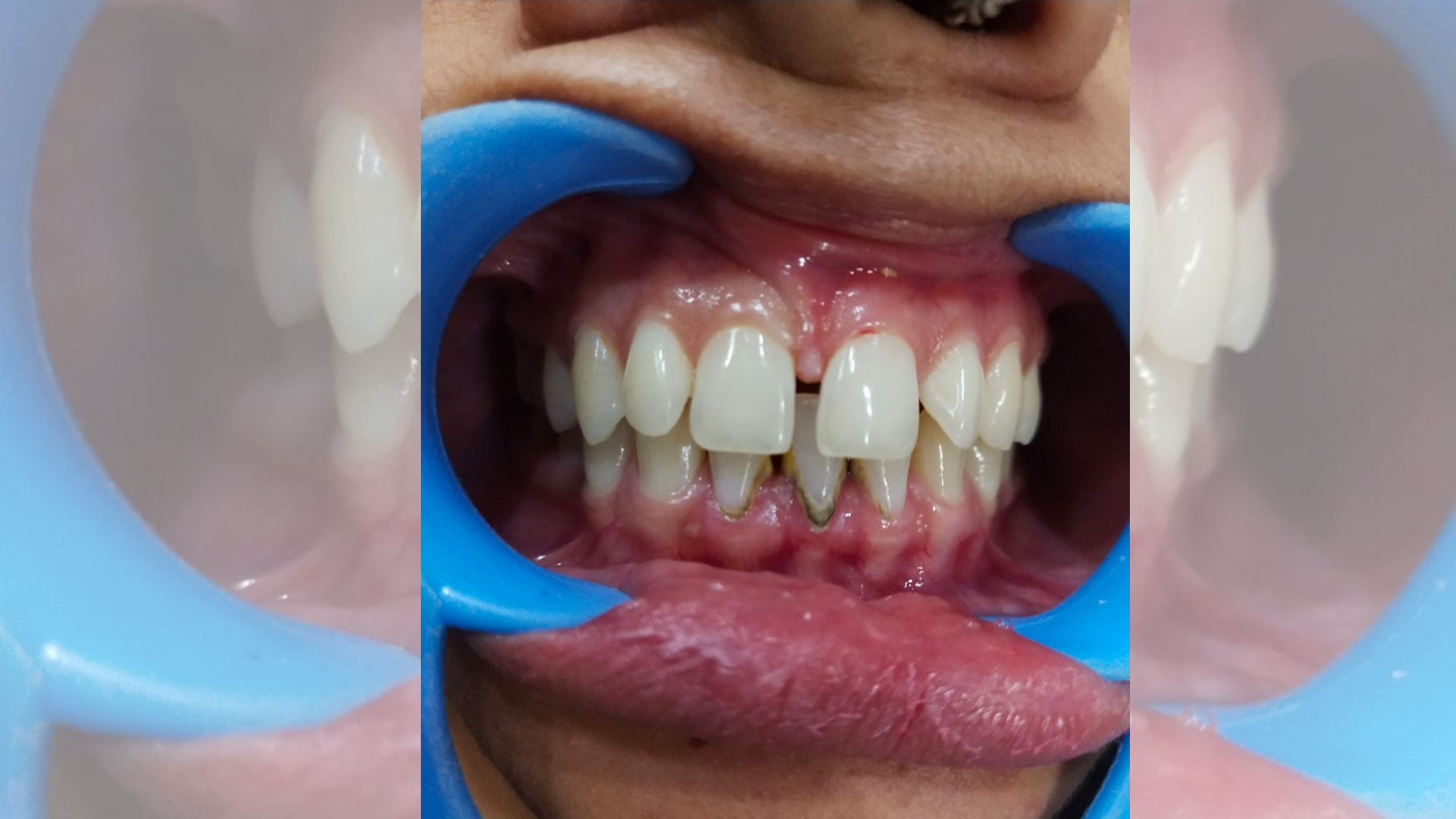 Midline Closure 2
