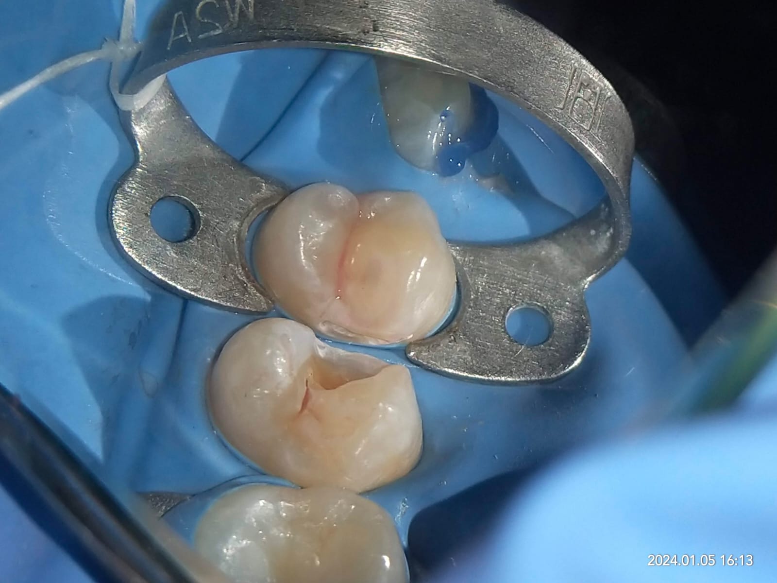 Carious Tooth 1
