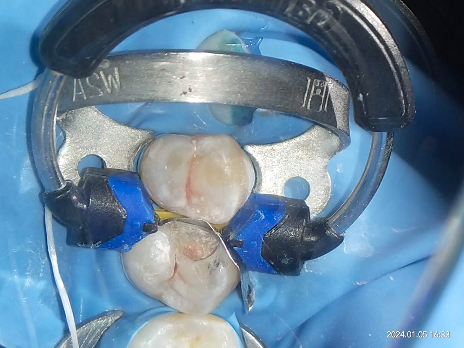 Carious Tooth 2