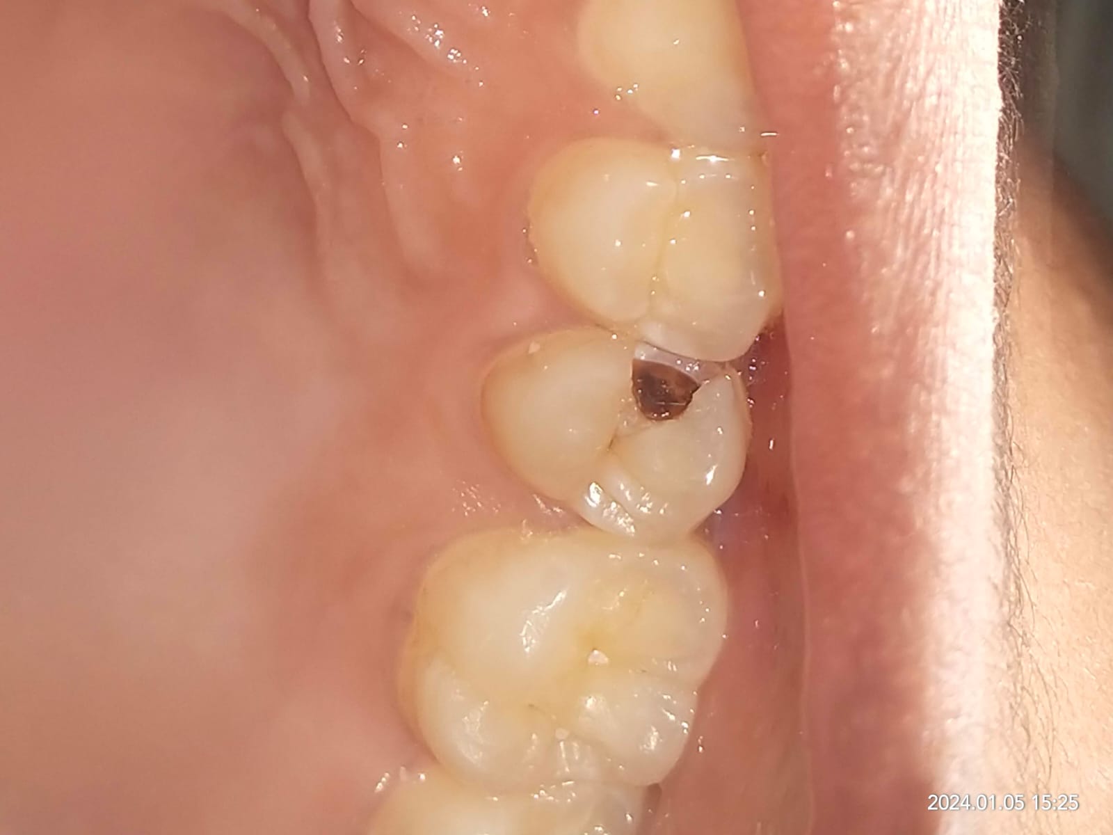 Carious Tooth 3
