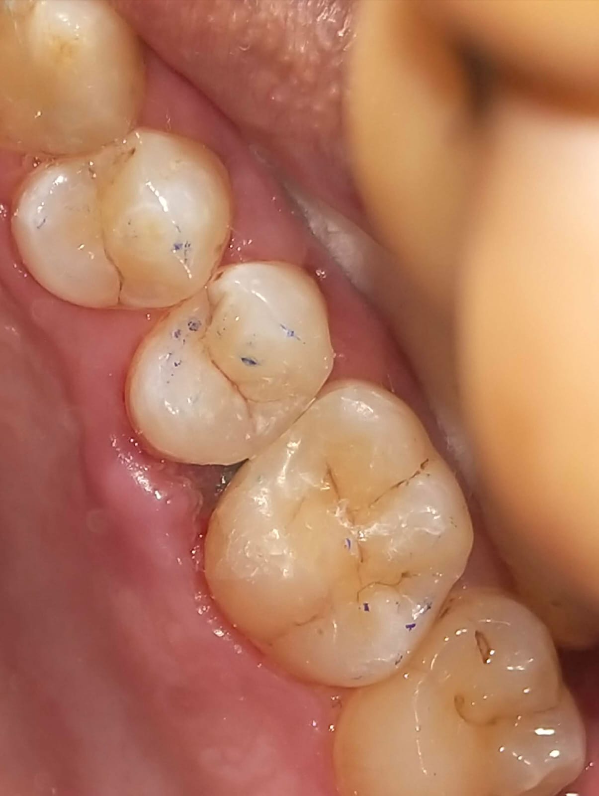 Carious Tooth 4